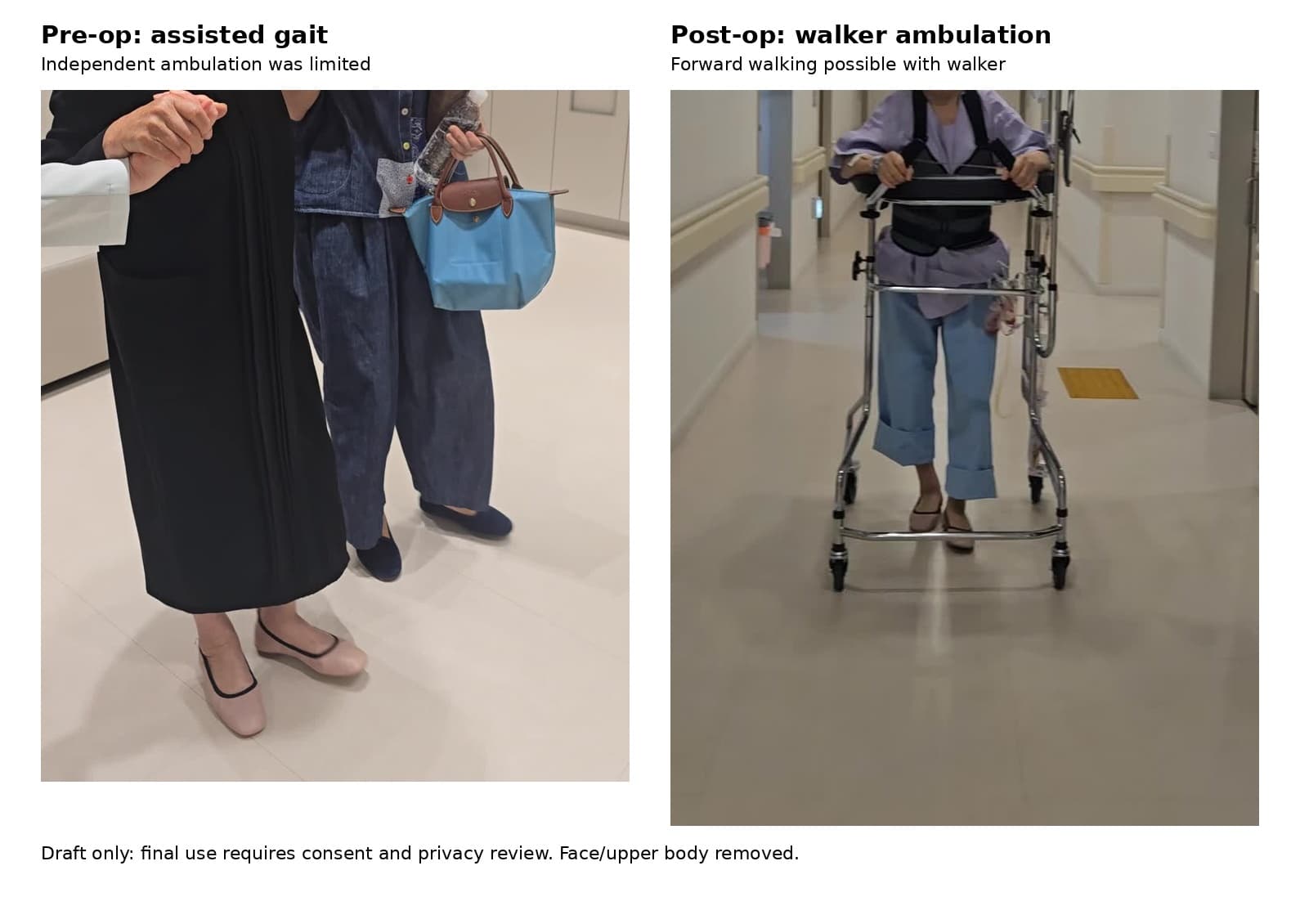De-identified lower-body gait observation for a lumbosacral transitional vertebra educational case.