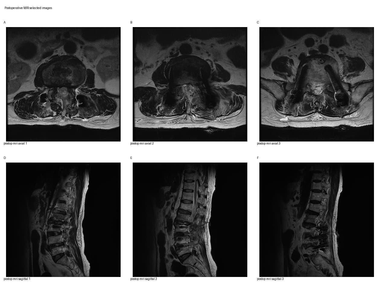 De-identified postoperative MRI after UBE-ULBD and Biportal Endoscopic TLIF for multilevel lumbar stenosis with L6 lumbarization.
