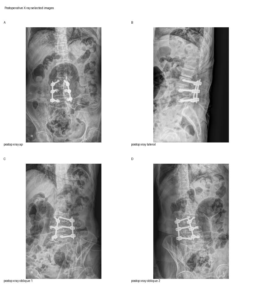 De-identified postoperative radiograph after UBE-ULBD and Biportal Endoscopic TLIF for multilevel lumbar stenosis with L6 lumbarization.