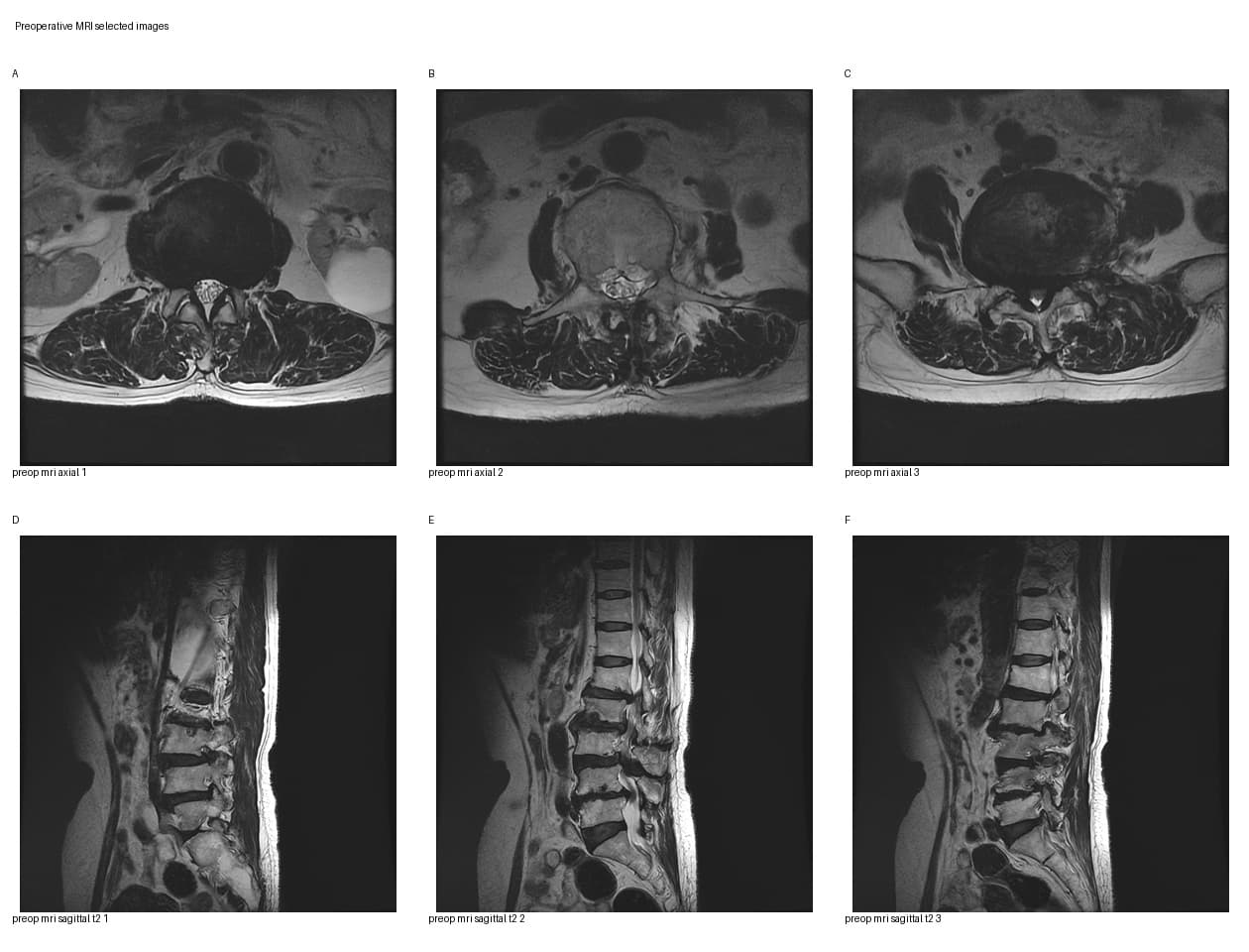 De-identified preoperative MRI for multilevel lumbar stenosis with L6 lumbarization educational case.
