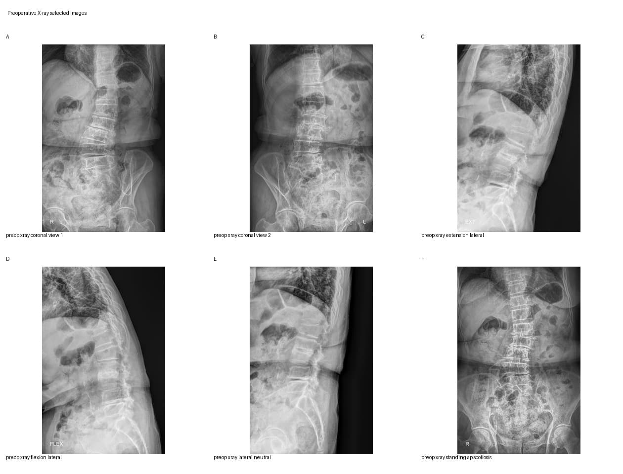 De-identified preoperative radiograph for multilevel lumbar stenosis with L6 lumbarization educational case.