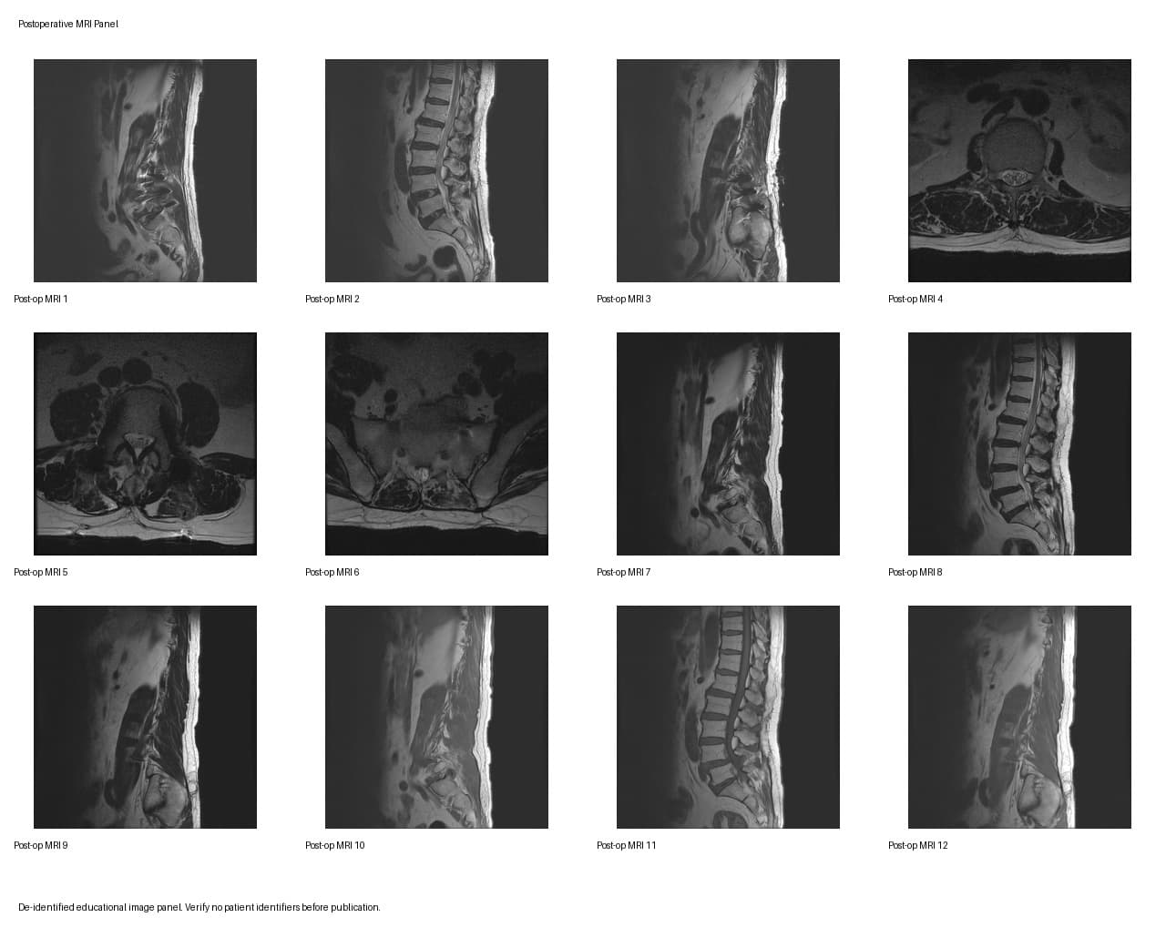 De-identified postoperative MRI after UBE-TLIF L4-5-S1 for post-laminectomy recurrent stenosis and bilateral foraminal stenosis.