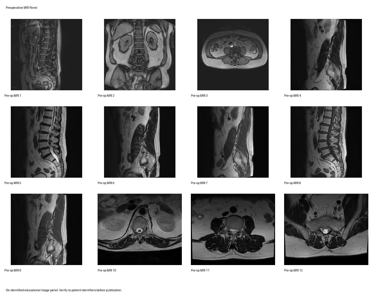 De-identified preoperative MRI for post-laminectomy recurrent stenosis and bilateral foraminal stenosis educational case.