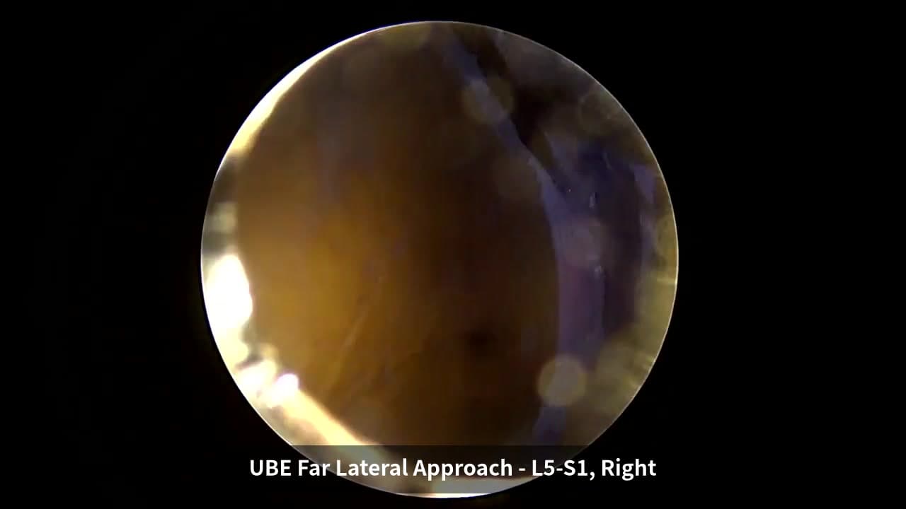 Operative teaching video: Right L5–S1 far-lateral biportal decompression and discectomy