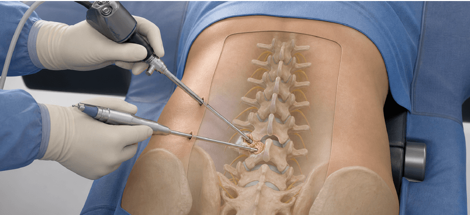 AI-generated 3D illustration of lumbar nerve decompression through a biportal endoscopic approach