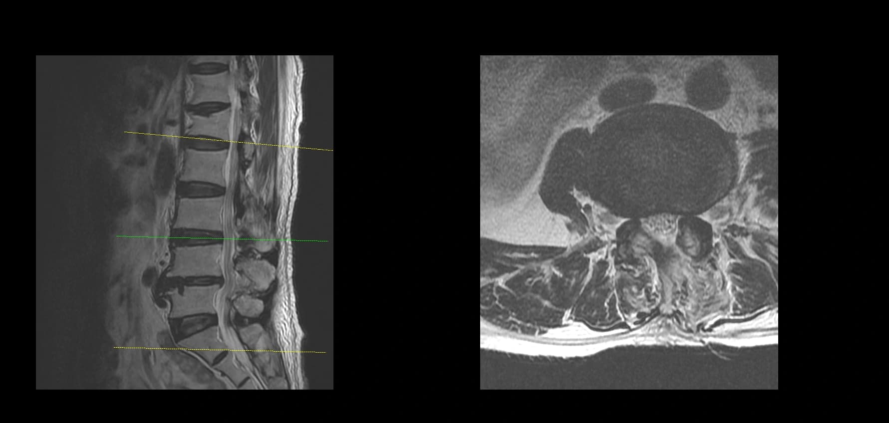 De-identified postoperative sagittal lumbar MRI after endoscopic decompression.