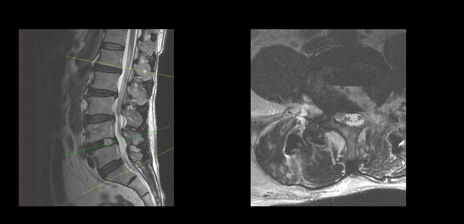 De-identified postoperative axial lumbar MRI after UBE-TLIF.