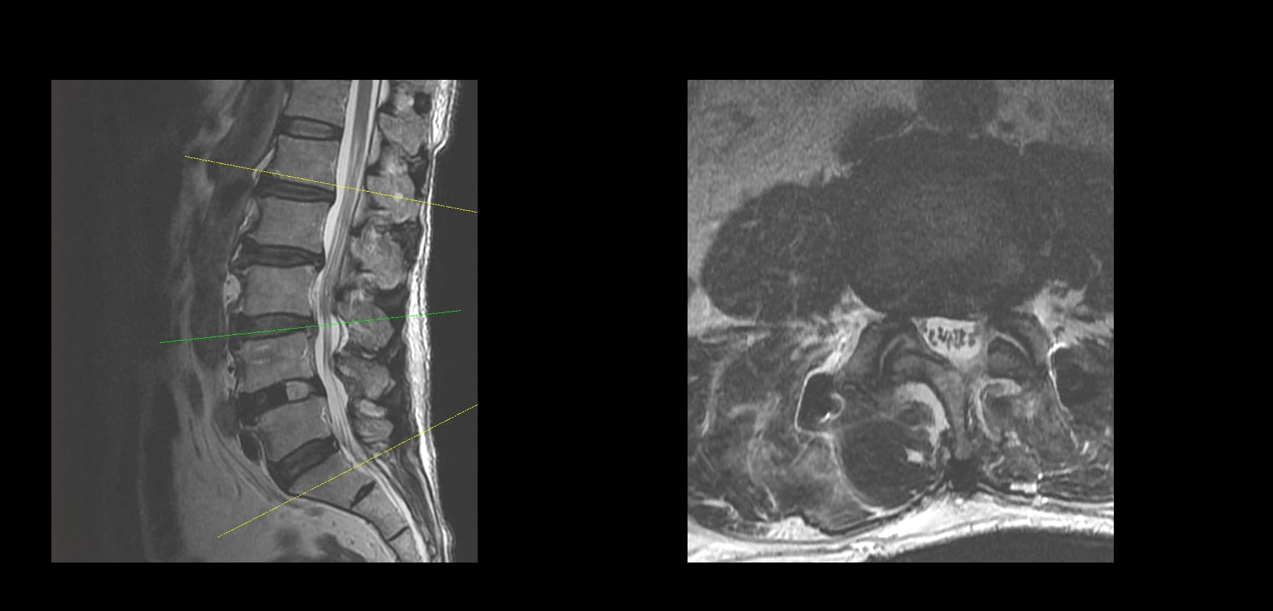 De-identified postoperative sagittal lumbar MRI after UBE-TLIF.