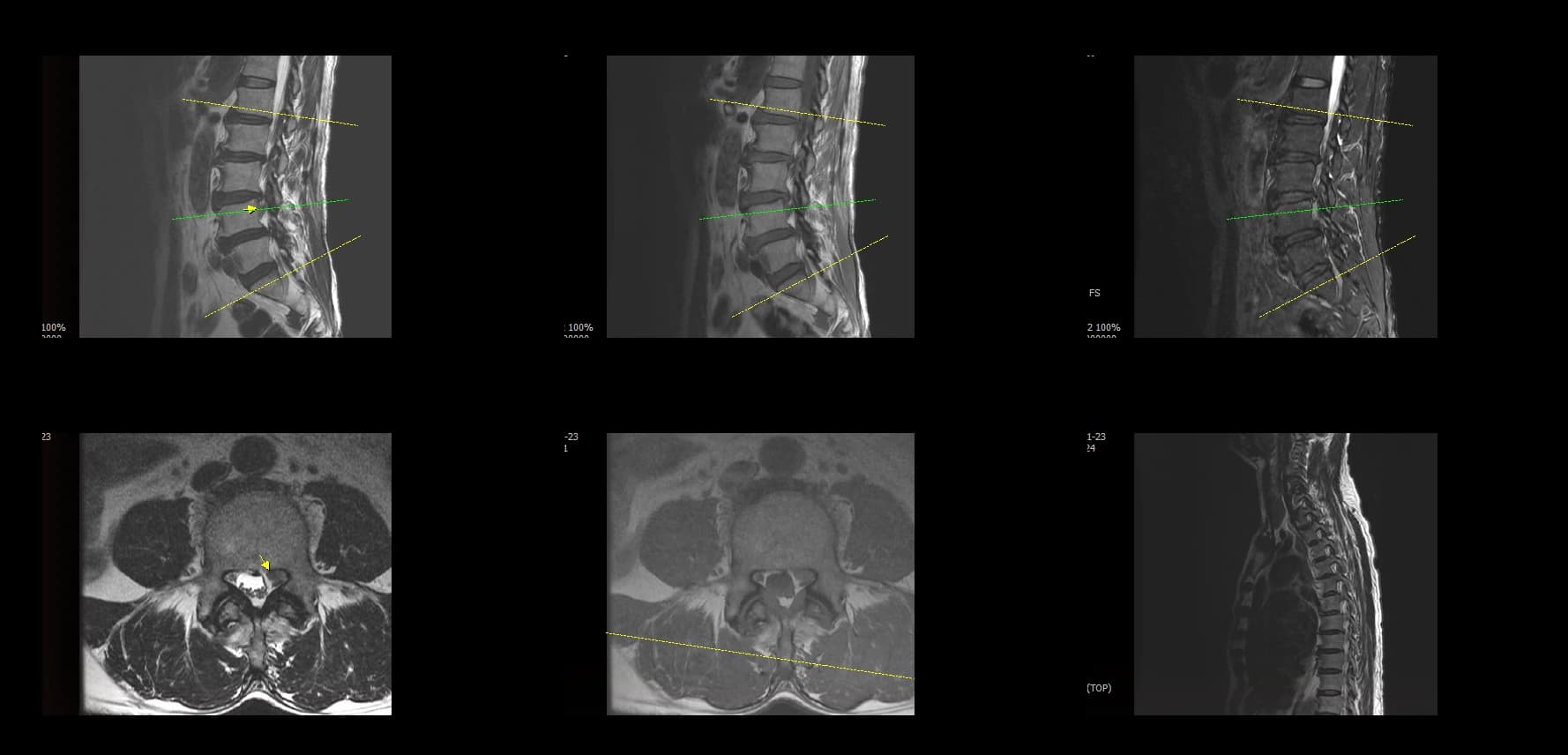 De-identified preoperative sagittal lumbar MRI for UBE-TLIF case.