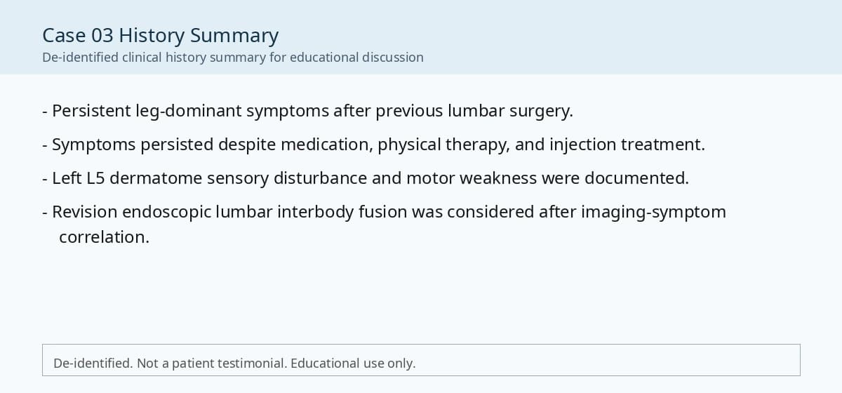 De-identified history summary for revision endoscopic lumbar interbody fusion case.