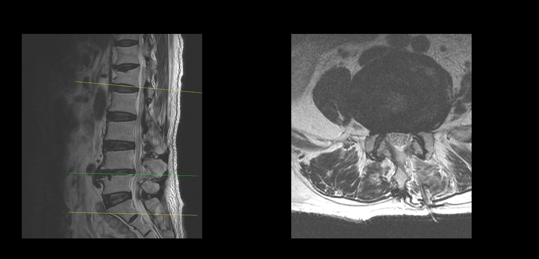 De-identified postoperative axial lumbar MRI after revision endoscopic fusion.