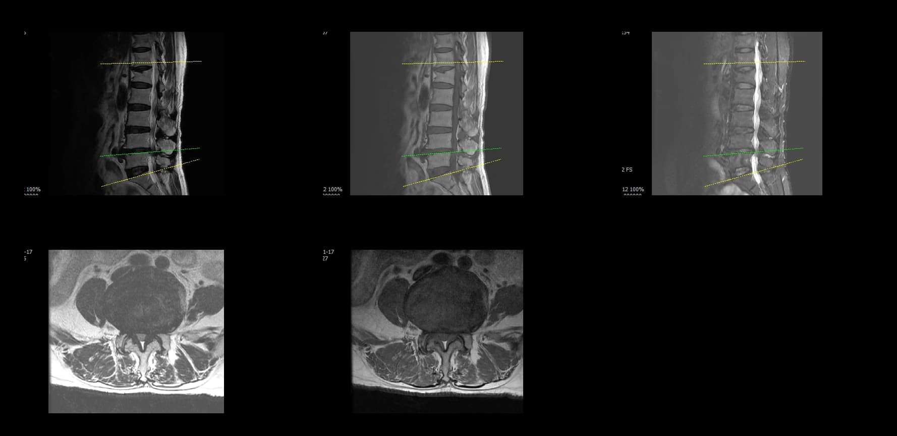De-identified preoperative axial lumbar MRI for revision endoscopic fusion case.