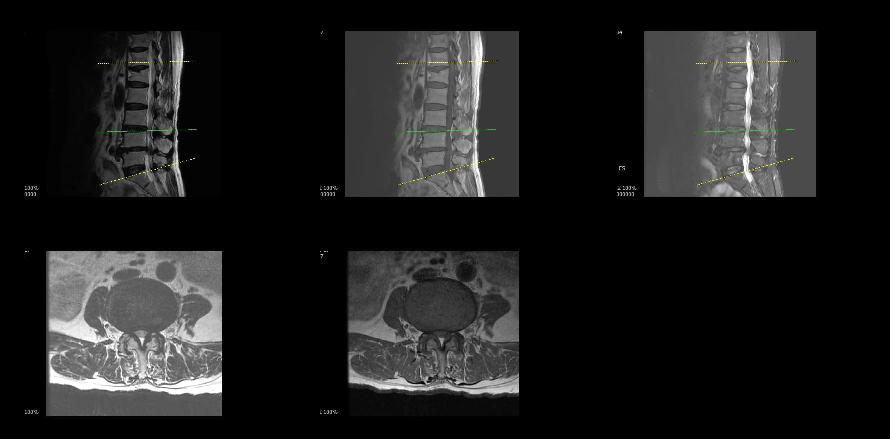De-identified preoperative sagittal lumbar MRI for revision endoscopic fusion case.