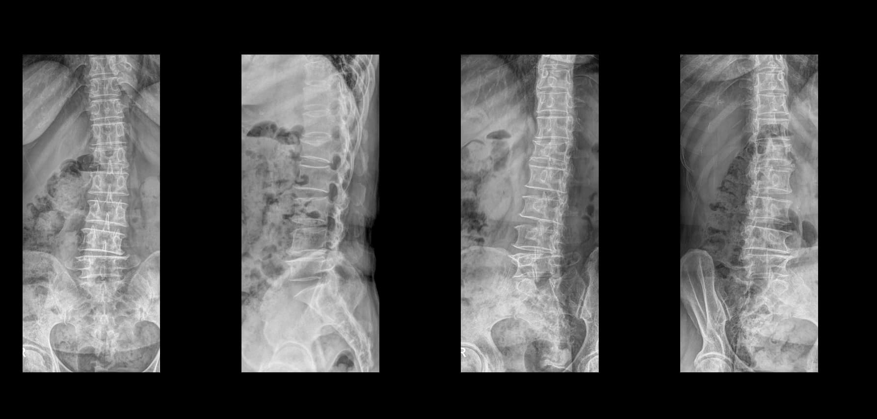 De-identified preoperative lumbar radiograph for revision fusion assessment.