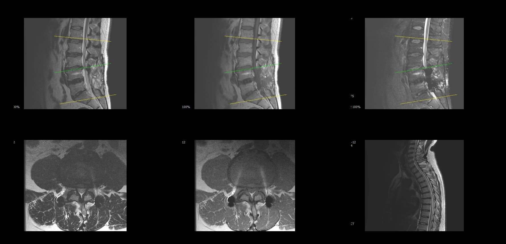 De-identified preoperative axial lumbar MRI demonstrating adjacent segment stenosis.