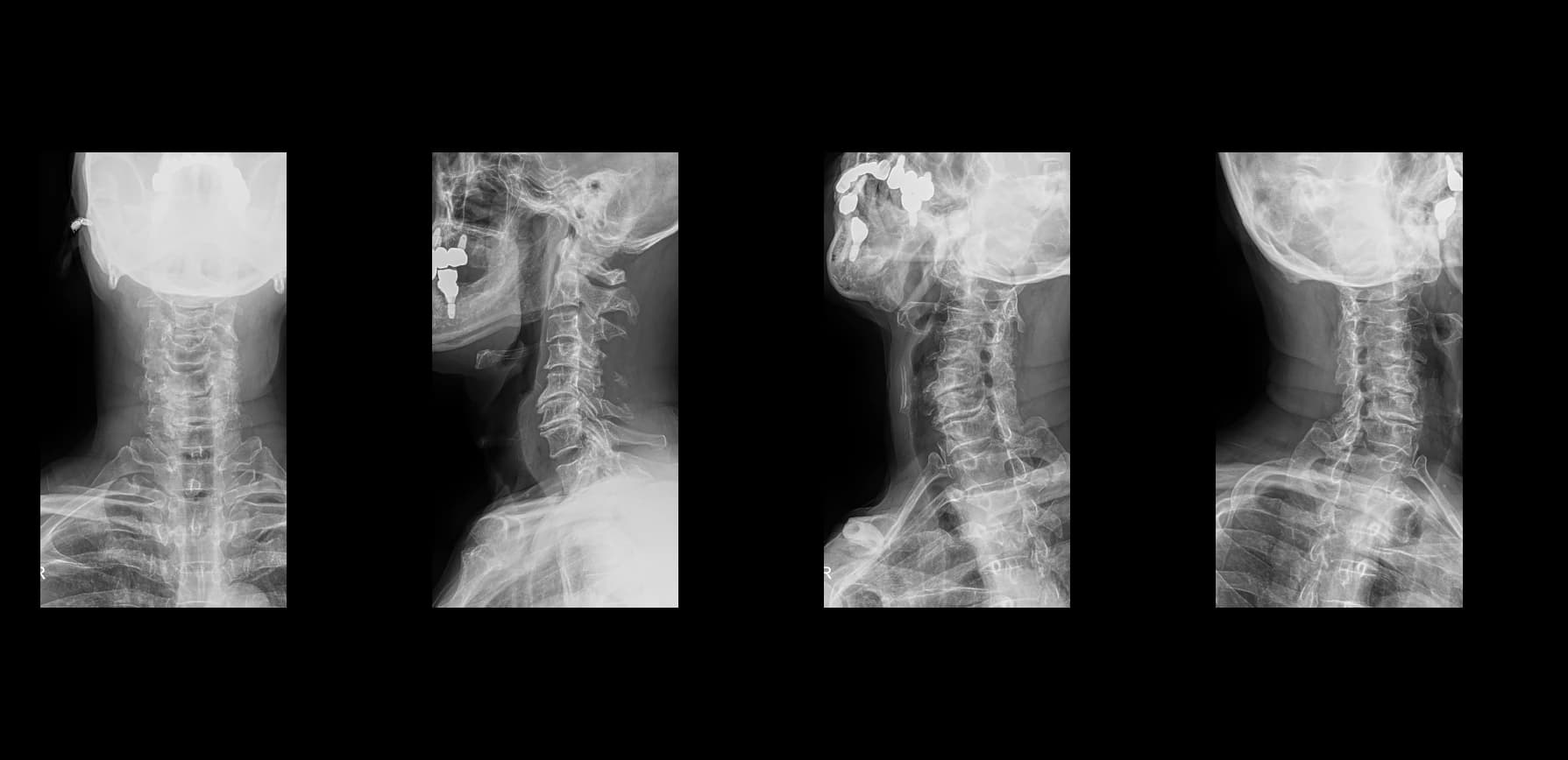 De-identified postoperative cervical radiograph after endoscopic cervical decompression.