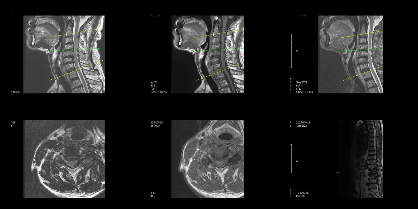 De-identified preoperative sagittal cervical MRI demonstrating cervical stenosis.