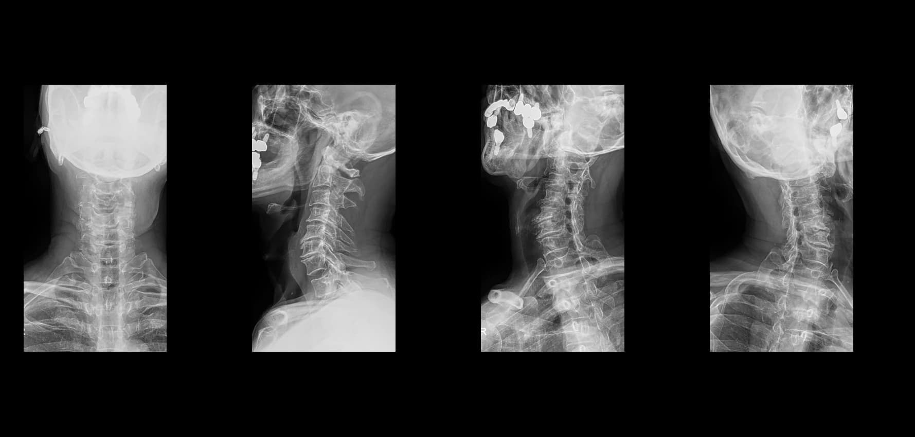 De-identified preoperative cervical radiograph for CSM case.