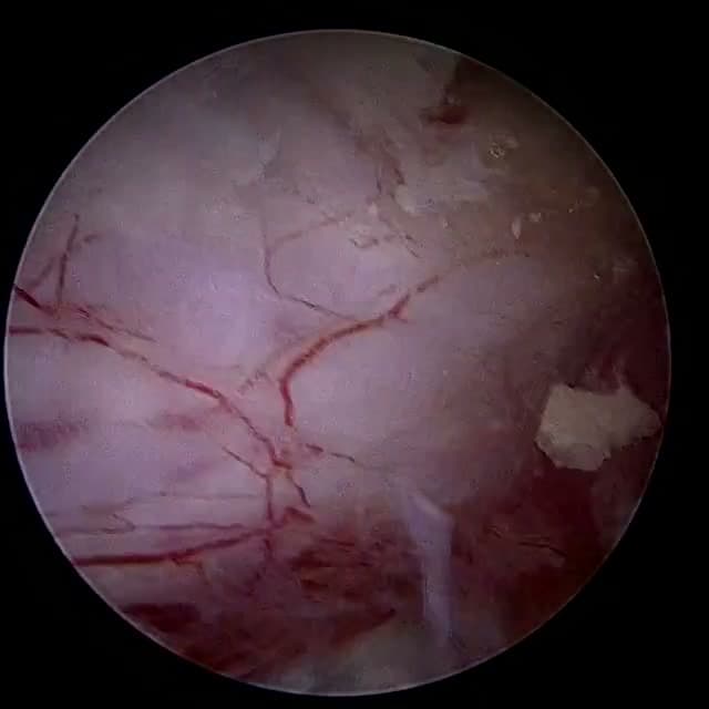 Endoscopic operative field