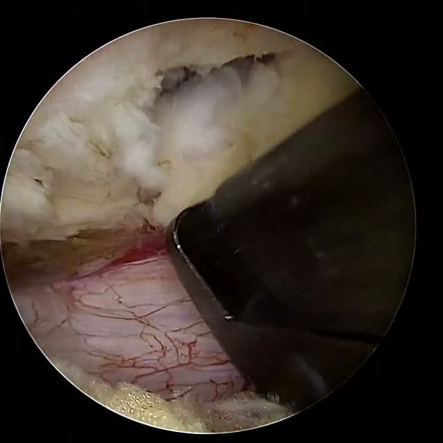 Endoscopic operative field