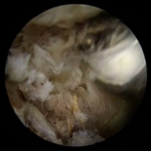 Endoscopic operative field