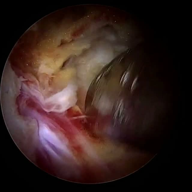 Endoscopic operative field