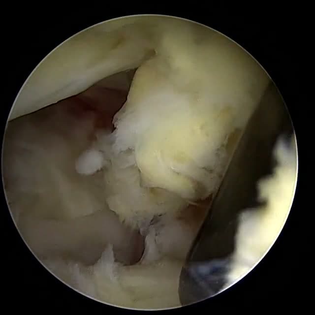 Endoscopic operative field