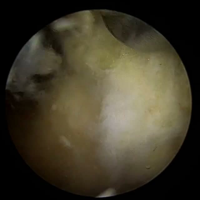 Endoscopic operative field