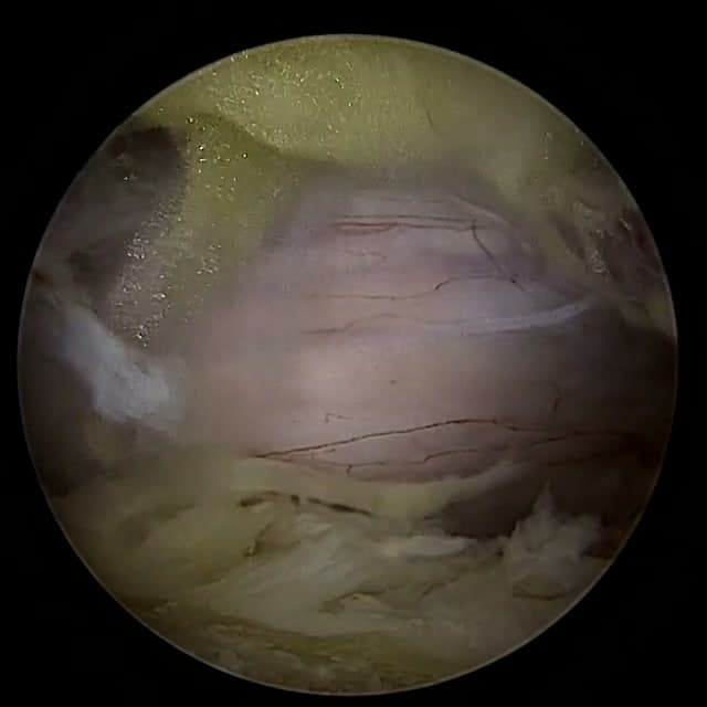 Endoscopic operative field