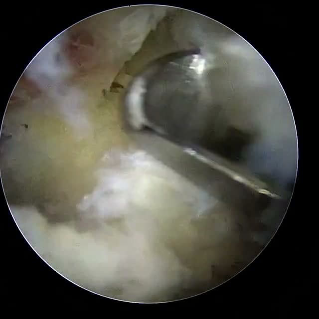 Endoscopic operative field