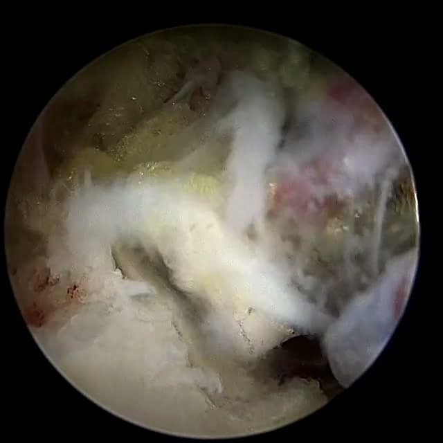 Endoscopic operative field