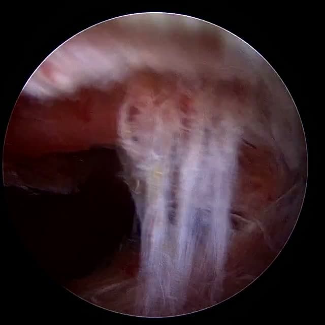 Endoscopic operative field