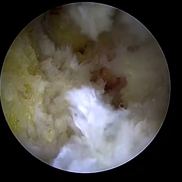 Endoscopic operative field