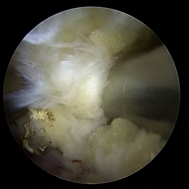 Endoscopic operative field
