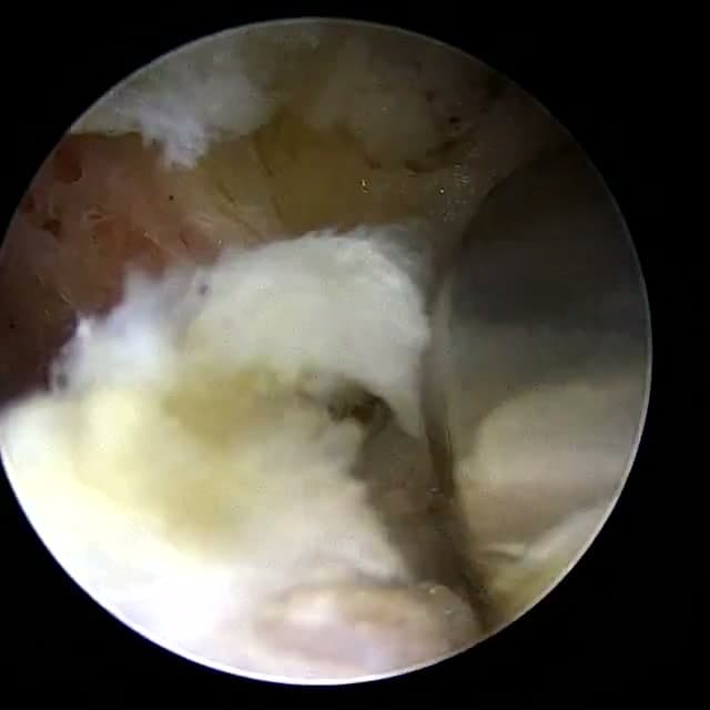 Endoscopic operative field