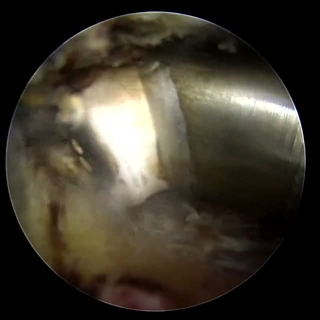 Endoscopic operative field