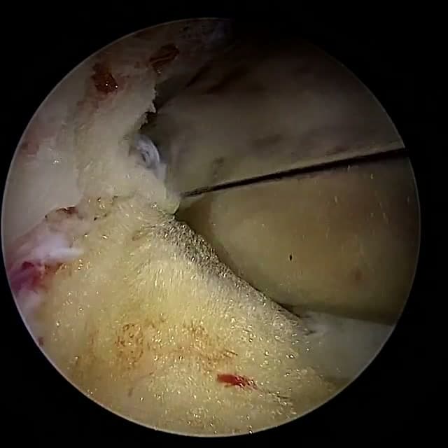 Endoscopic operative field