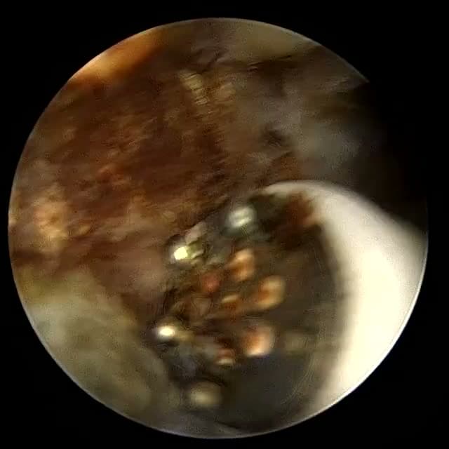 Endoscopic operative field