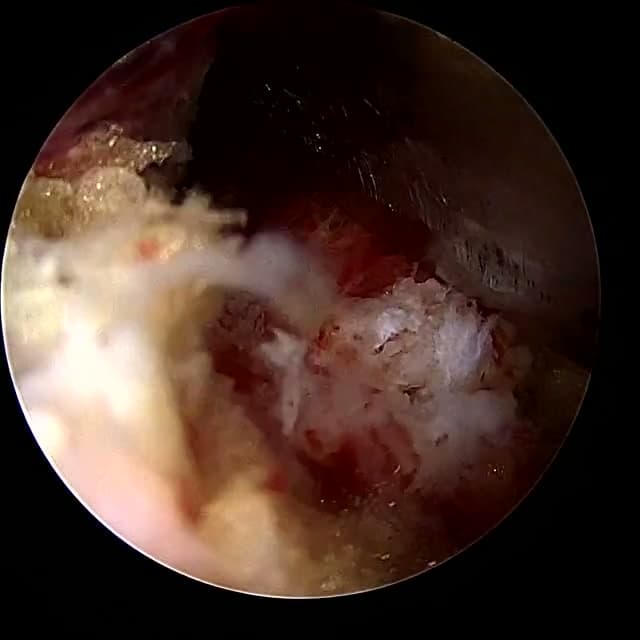 Endoscopic operative field