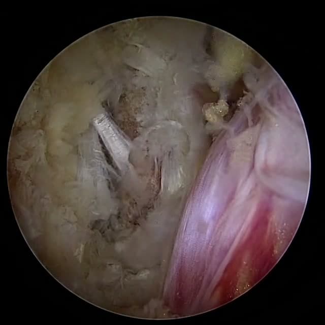 Endoscopic operative field