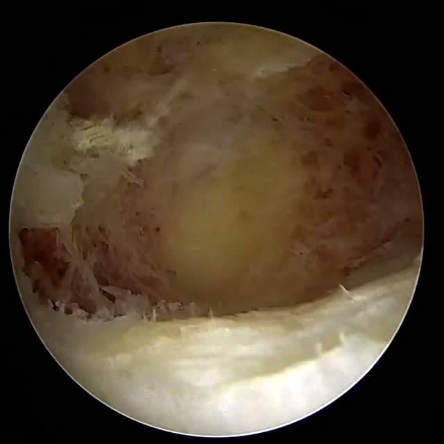 Endoscopic operative field