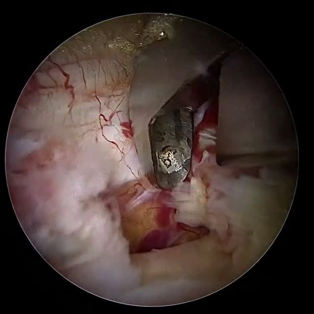 Endoscopic operative field