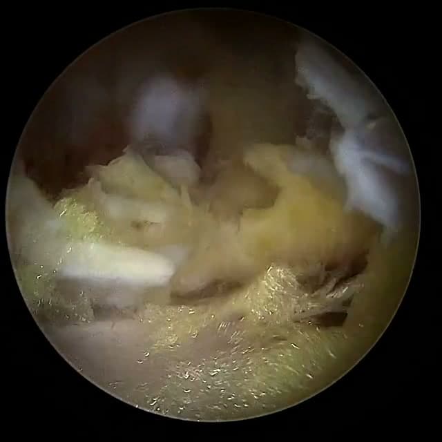 Endoscopic operative field