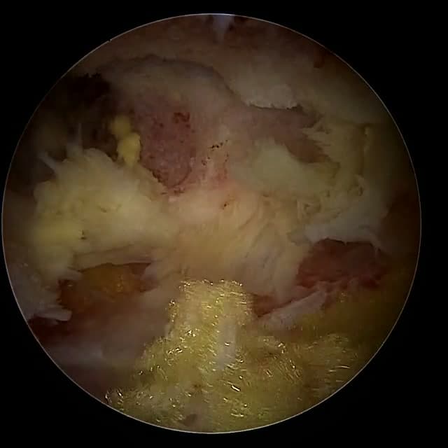 Endoscopic operative field