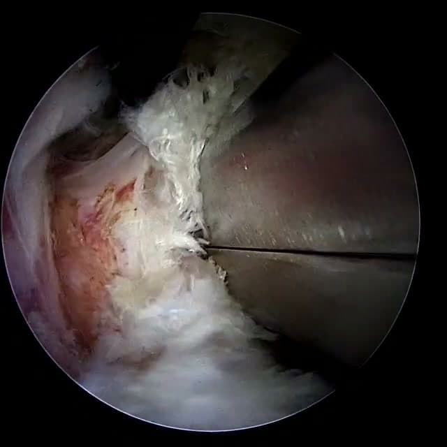 Endoscopic operative field
