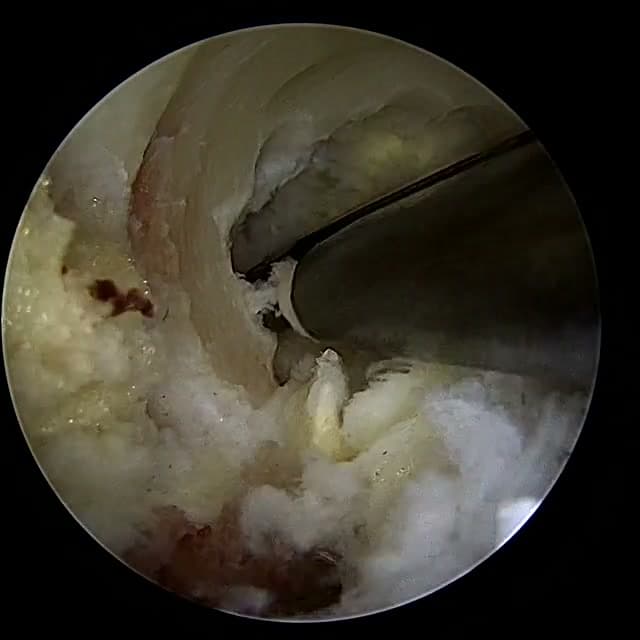 Endoscopic operative field