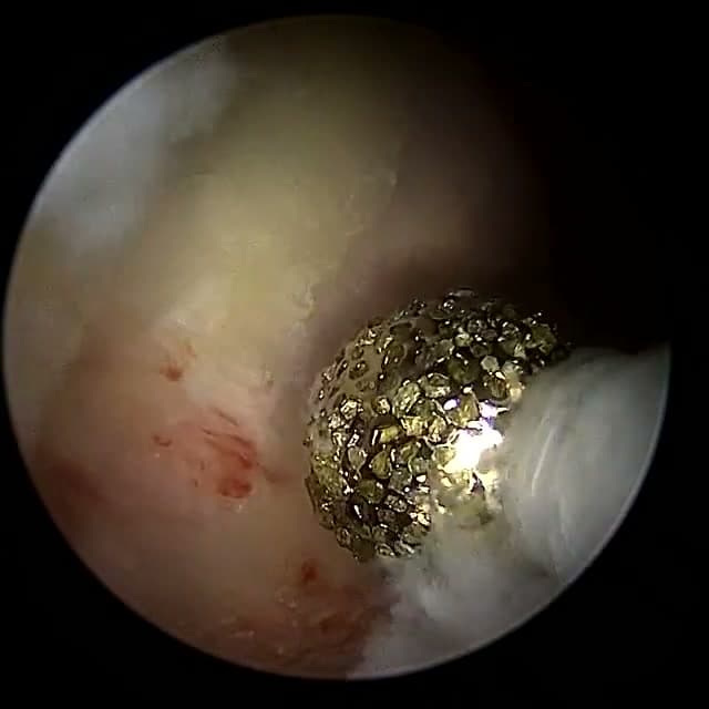 Endoscopic operative field