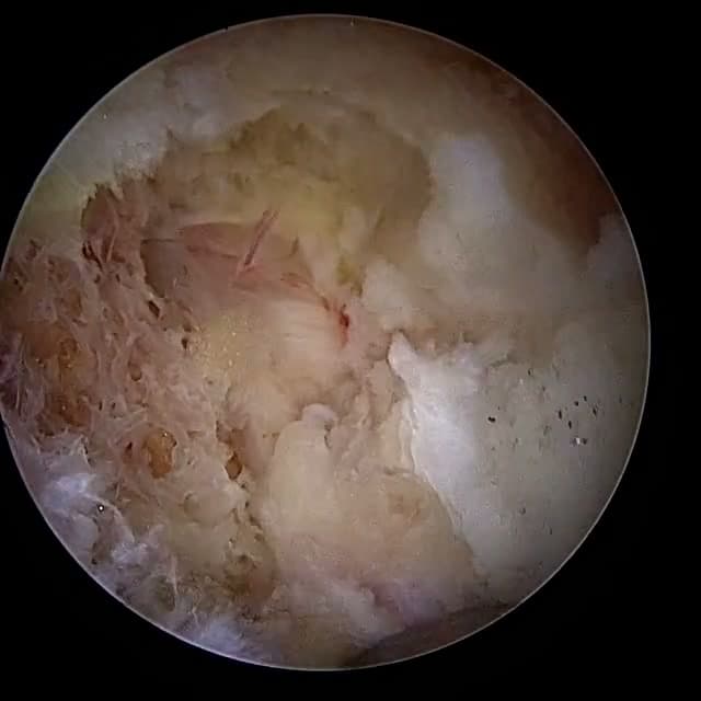 Endoscopic operative field