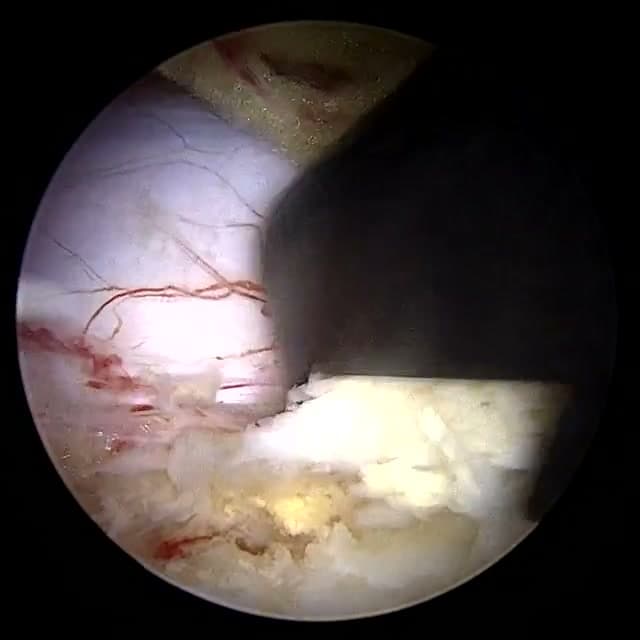 Endoscopic operative field