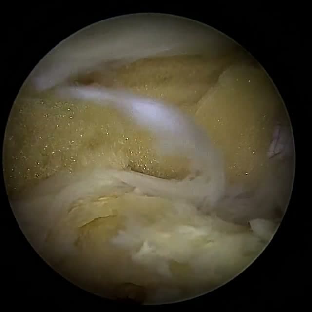Endoscopic operative field